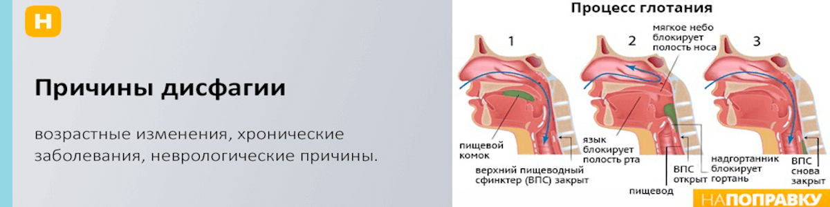 Нарушение глотания жевания