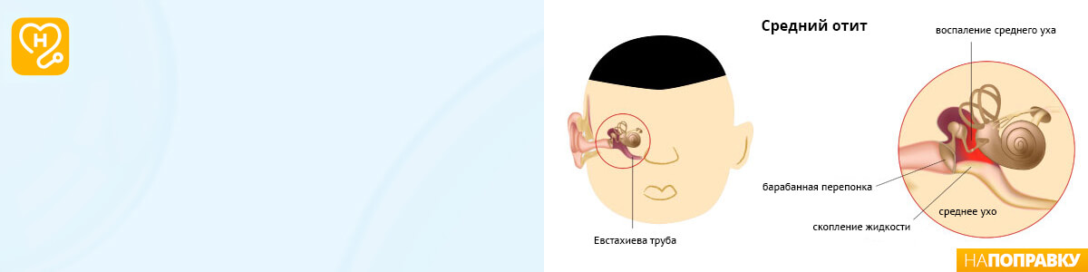 Отит: симптомы, причины, диагностика и лечение