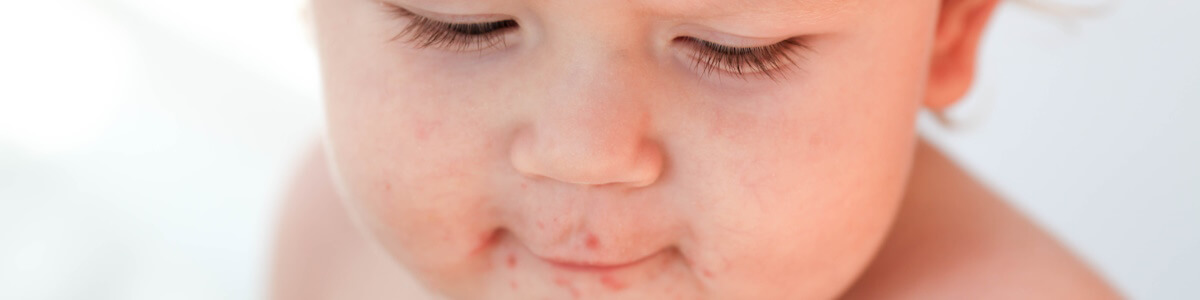 Вопрос на тему «Сыпь на голове у ребенка - как лечить?»