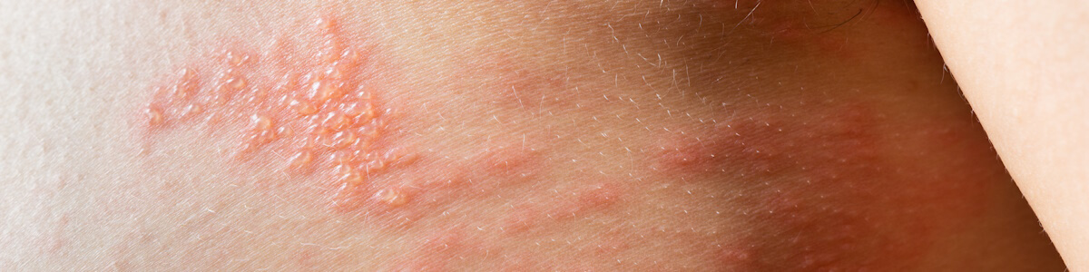 Виды дерматита (фото) - атопический, контактный, себорейный и другие виды дерматита