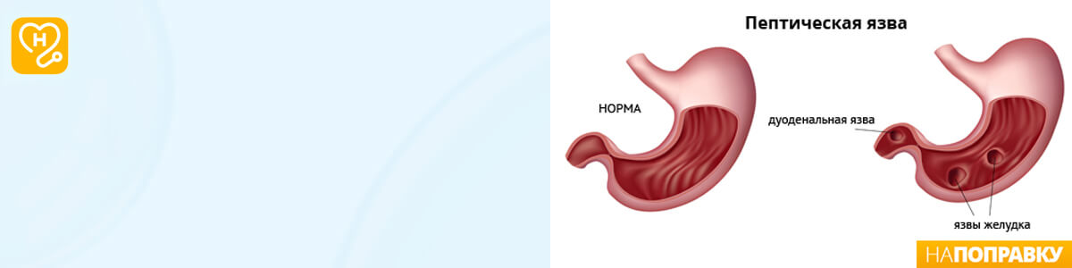 Язва желудка и двенадцатиперстной кишки
